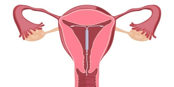 Đặt vòng tránh thai (https://www.netdoctor.com/)