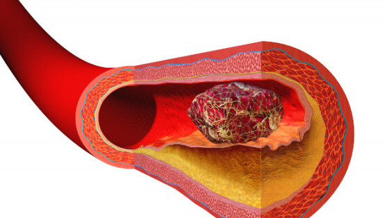 Xơ vữa động mạch và cục máu đông (Nguồn ảnh: Cardiovascularbusiness)