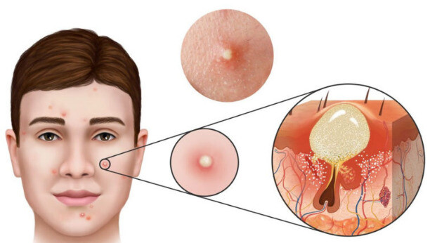 Doxycycline thường được các bác sĩ da liễu kê đơn điều trị mụn trứng cá mủ. Nguồn ảnh: Pinterest 