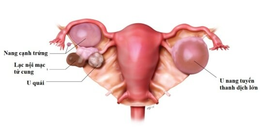 U nang buồng trứng có đường kính lớn hơn 5cm sẽ được cân nhắc phẫu thuậ cắt bỏ - Nguồn ảnh: childrenscolorado.org