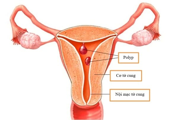 Polyp tử cung (nguồn ảnh: https://www.mayoclinic.org/) 