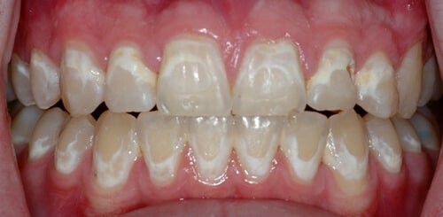Vùng mất chất khoáng (những đốm trắng) là dấu hiệu ban đầu của bệnh sâu răng 