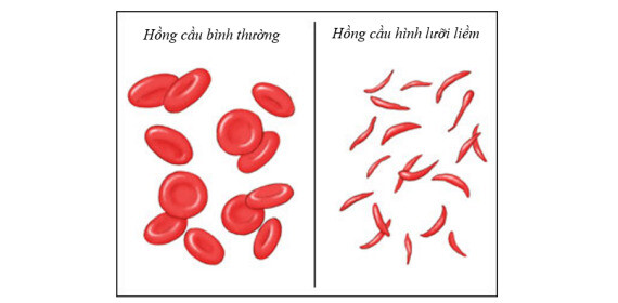 Bệnh hồng cầu hình lưỡi liềm