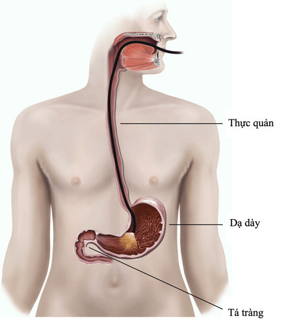 Nội soi đường tiêu hoá trên là phương pháp giúp chẩn đoán và điều trị. (Nguồn ảnh: www.healthdirect.gov.au)