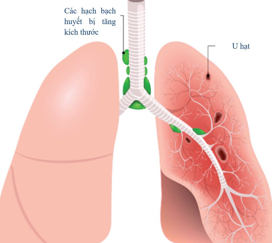 Bệnh sarcoidosis ở phổi (nguồn: https://www.lungandsleepspecialists.com/) 