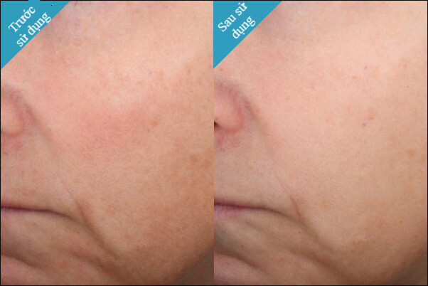 Trước và sau khi sử dụng Retinol 1.0. Nguồn: skinceuticals.com 