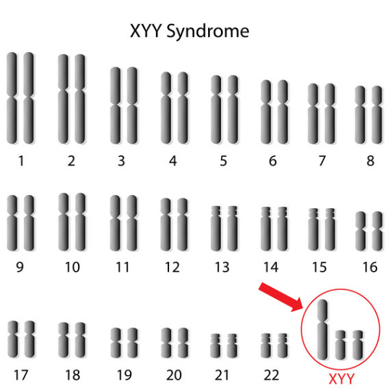 Bất thường bộ nhiễm sắc thể(NST) ở người mắc hội chứng siêu nam, mũi tên (Nguồn ảnh: MedinePlus)