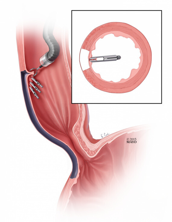 Kẹp chuyên dụng là một phương pháp giúp điều trị xuất huyết tiêu hoá trong một số bệnh lý. (Nguồn ảnh: www.ctsnet.org)