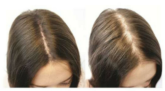 Hói đầu theo theo ngôi tóc ở nữ giới. Nguồn ảnh: Clive Hair Clinics