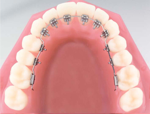 Nguồn: Our Invisalign v Lingual Braces Blog 