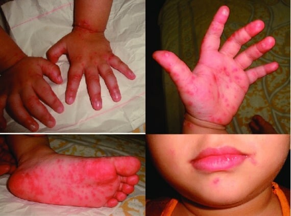 Bệnh tay chân miệng đặc trưng bởi các mụn nước, vết loét trong miệng, phát ban trên bàn tay và bàn chân. (nguồn: researchgate.net)