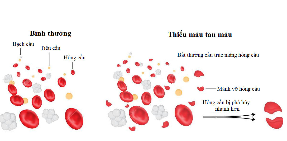 Thiếu máu tan máu có thể gây nhiều biến chứng đe dọa tính mạng. Nguồn ảnh: 123rf.com 