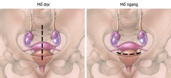 (Vị trí vết sẹo khi mở ổ bụng để nội soi ổ bụng - nguồn ảnh: Mayo clinic) 