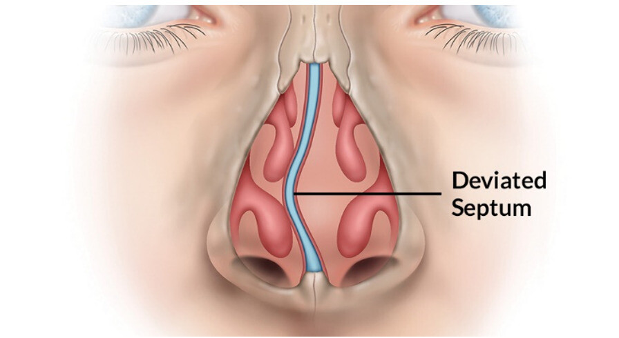 Hình ảnh lệch vách ngăn mũi ( Nguồn ảnh: https://www.stlsinuscenter.com/) 