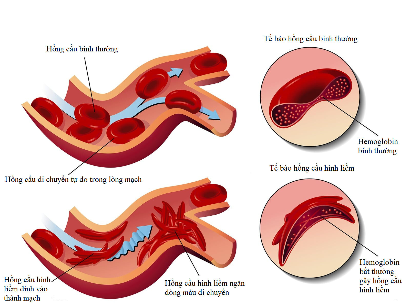 Bệnh thiếu máu hồng cầu hình liềm. Nguồn ảnh: Leogenic.com 