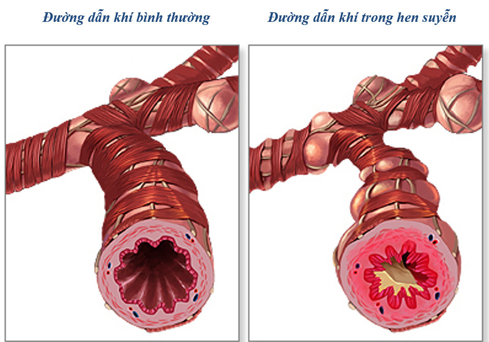 Đường thở trong hen suyễn (nguồn: https://medlineplus.gov/) 