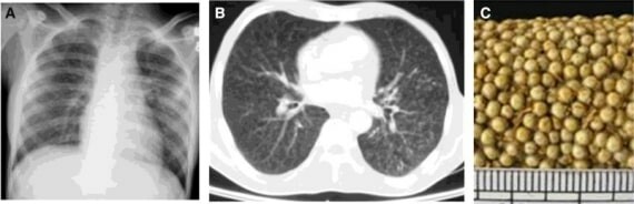 Hình: A. XQ phổi của lao kê.   B. CT phổi của lao kê.   C. Hạt kê. Nguồn: ResearchGate