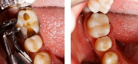 Khi trám răng, nha sĩ trước tiên sẽ sử dụng một dụng cụ để loại bỏ bất kỳ khu vực nào bị ảnh hưởng bởi sâu răng và lấp đầy lỗ sâu bằng vật liệu như nhựa, sứ... (nguồn: https://www.droshetski.com)
