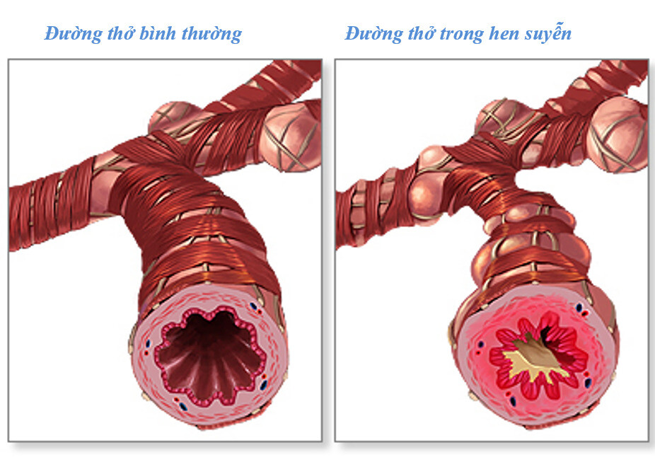 Minh họa đường thở trong bệnh hen suyễn (nguồn: https://medlineplus.gov/) 