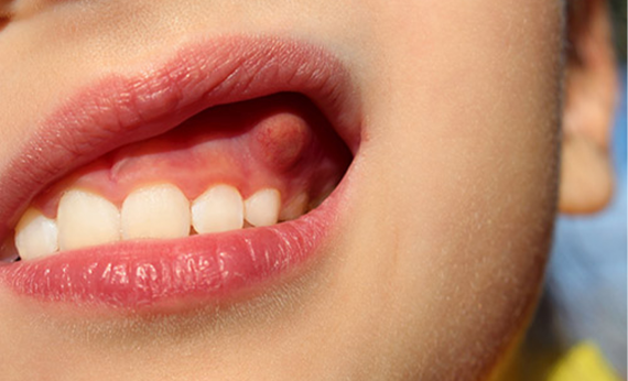 Sâu răng có thể gây ra các khối áp xe trong miệng. (nguồn: dentistchannel.online)
