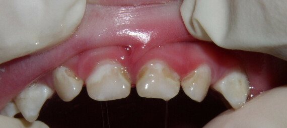 Dấu hiệu đầu tiên của sâu răng có thể xuất hiện dưới dạng các đốm trắng ở viền nướu trên răng cửa trên. (nguồn: pediatricdentistsf.dentis)