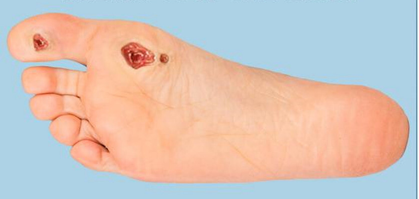 Biến chứng ở bàn chân trong bệnh tiểu đường, thường gặp là nhiễm trùng và vết loét không lành.  (Nguồn mass4d.com) 