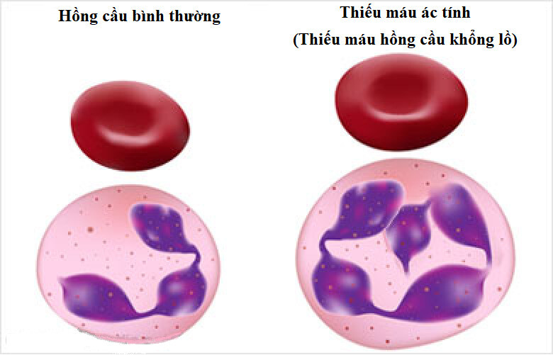 Thiếu máu ác tính thường do phản ứng tự miễn của cơ thể. Nguồn ảnh: Docplayer.cz 