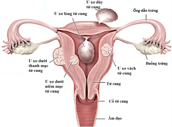 U xơ tử cung là bệnh lý phụ khoa phổ biến ở mọi độ tuổi của phụ nữ, Đây là hiện tượng các khối mụn thịt mọc bất thường từ cơ tử cung – Nguồn ảnh: femmeinstitute.com