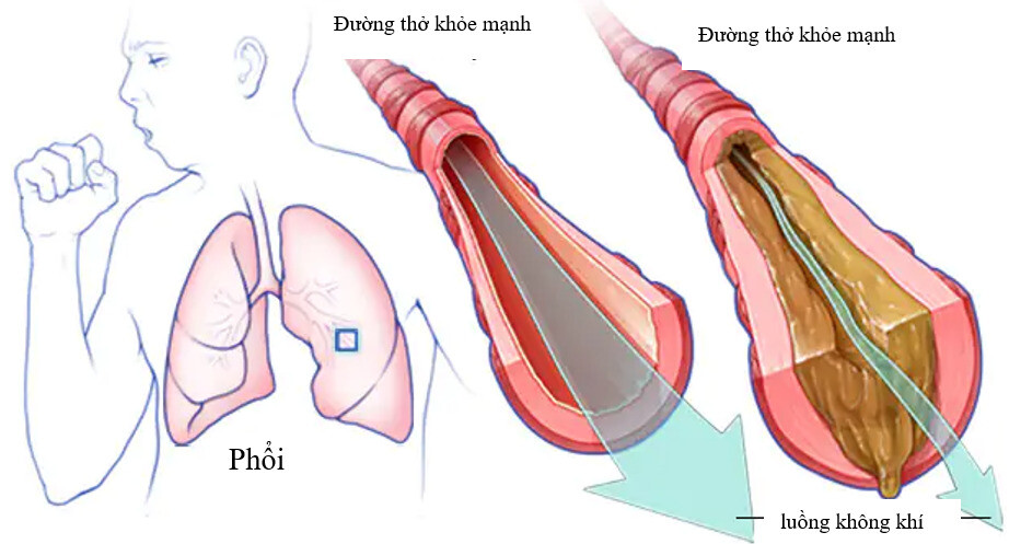 Bệnh xơ nang (nguồn: https://www.mayoclinic.org/) 