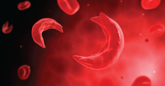 Hồng cầu có hình dạng bất thường trong bệnh thiếu máu hồng cầu hình liềm (nguồn ảnh: https://www.gehealthystayhealthy.com/)