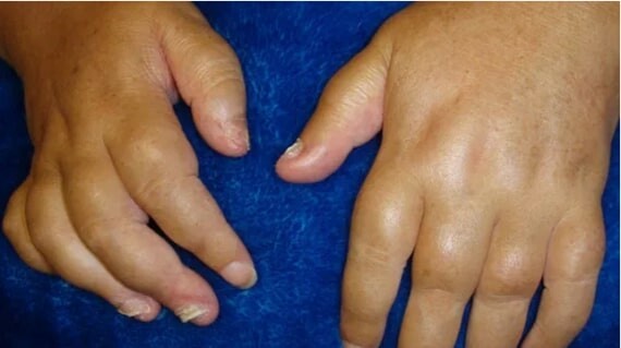 Ngón tay hình xúc xích thường là biểu hiện sớm của viêm khớp vảy nến. Theo nguồn: healthline.com.