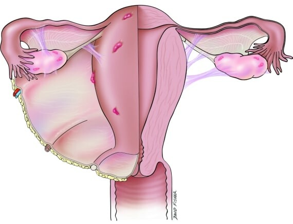Những tổn thương do lạc nội mạc tử cung hình thành mô sẹo gây dính vùng chậu về sau – Nguồn ảnh: cureus.com