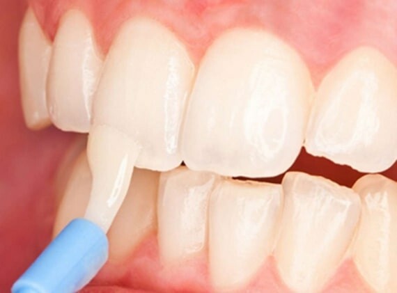 Fluor được bôi lên răng dưới dạng gel hoặc kem để điều trị và phòng ngừa sâu răng. (nguồn: stunningdentistry.com)