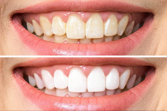 Việc đổi màu răng do niềng răng có kéo dài vĩnh viễn không? - Ảnh 1