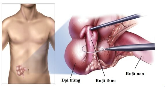 Phẫu thuật cắt bỏ là chỉ định chủ yếu điều trị viêm ruột thừa – Nguồn ảnh: arhamsurgicalhospital.com