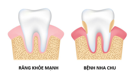 Bệnh nha chu là nguyên nhân gây mất răng hàng đầu trong các bệnh nha khoa (nguồn ảnh: https://www.enjoyyoursmile.com/)