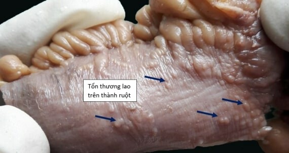 Lao ruột khi phân tích giải phẫu bệnh mô tổn thương. Nguồn: ilovepathology