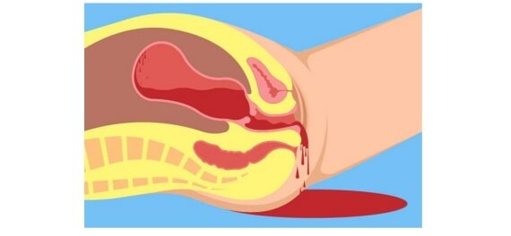 (Sau khi sinh, âm đạo sẽ tiết ra sản dịch - Nguồn ảnh: Ausmed) 