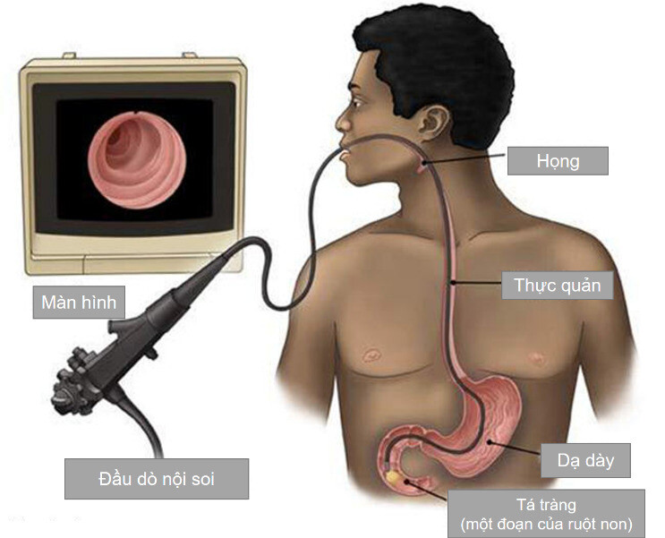 Nội soi sử dụng trong chẩn đoán viêm loét dạ dày tá tràng (nguồn ảnh: https://drbcshah.blogspot.com/)