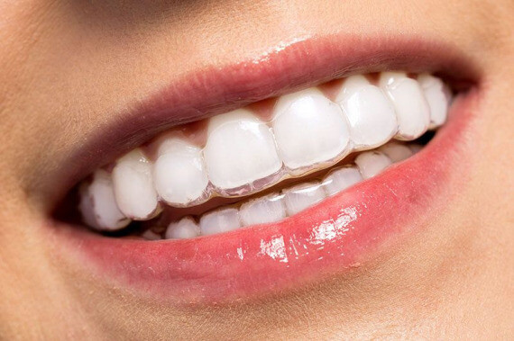 Niềng răng Invisalign