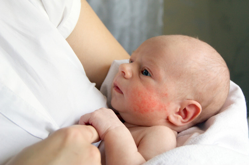 Viêm da dị ứng là phổ biến hơn ở trẻ sơ sinh và trẻ em 