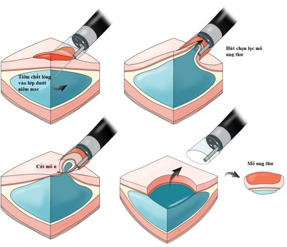 Phương pháp Cắt bỏ niêm mạc tiêu hóa qua nội soi – EMR (Endoscopic Mucosal Resection) – Nguồn ảnh: semanticscholar.org  