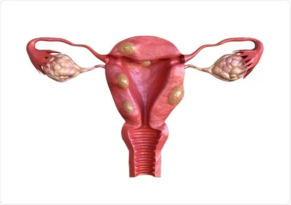 U xơ tử cung cũng là một nguyên nhân có thể gây chảy máu bất thường, nguồn: https://www.news-medical.net