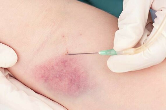 Bạn có thể bị bầm tím khi y tá chọc kim vào da để lấy máu, nguồn ảnh istockphoto.com
