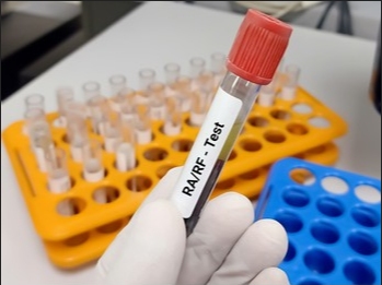 Xét nghiệm kháng thể RF, nguồn ảnh shutterstock.com