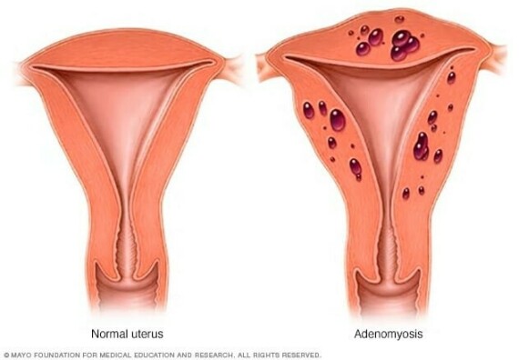 Hình ảnh bệnh cơ tuyến tử cung. Nguồn: Mayo Clinic