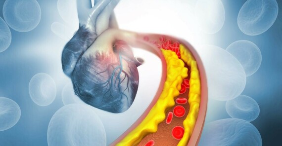 Theo NHLBI, cholesterol cao kéo dài có thể dẫn đến sự hình thành xơ vữa động mạch. Nguồn ảnh: onmanorama.com