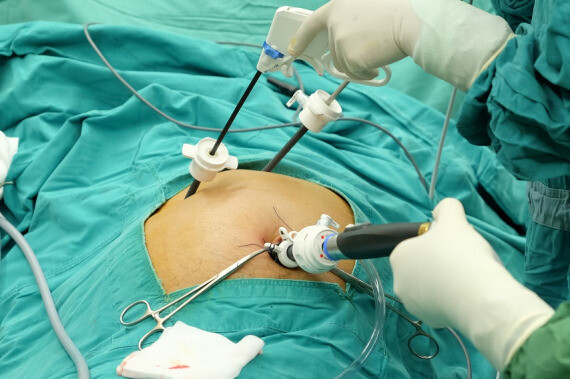 Cắt túi mật nội soi là phẫu thuật phổ biến nhất đối với sỏi mật. (nguồn: affinitysurgery.com)