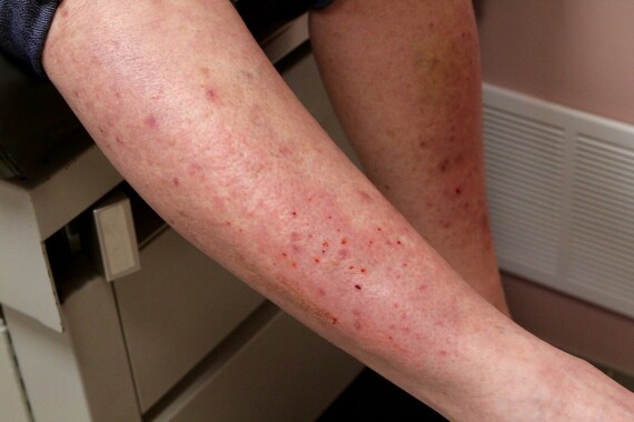 Viêm da dạng herpes ở vùng cẳng chân. Nguồn ảnh: gluten.org