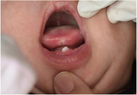 Một tình trạng tương đối hiếm gặp (1/2.000 – 1/3.000) là trẻ mới sinh ra đã có răng – gọi là răng sơ sinh.   (nguồn: internationalbreastfeedingjournal.biomedcentral.com)